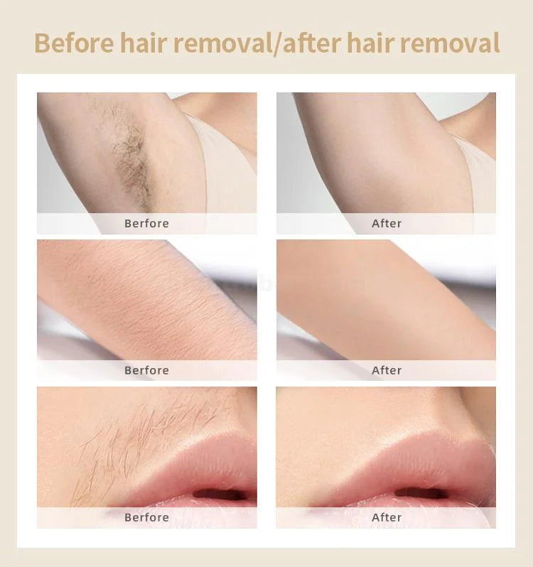 IPL Laser Hair Removal Handset for At-Home Hair Removal Treatment